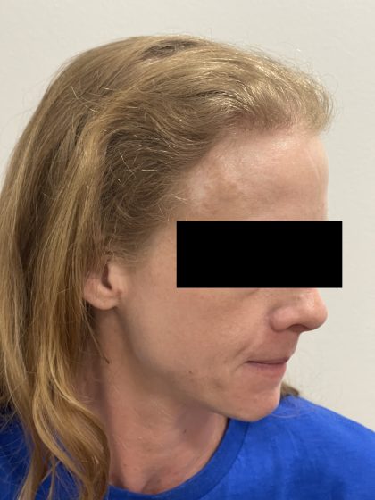 Hair Restoration Before & After Patient #246