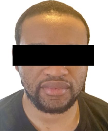 Hair Restoration Before & After Patient #241