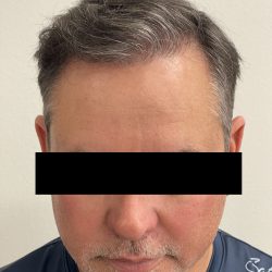 Hair Restoration Before & After Patient #247
