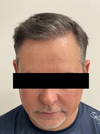 Hair Restoration Before & After Patient #247
