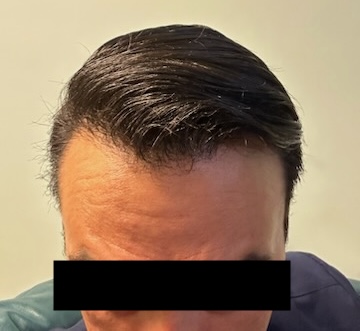 Hair Restoration Before & After Patient #245