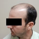 Hair Restoration Before & After Patient #243