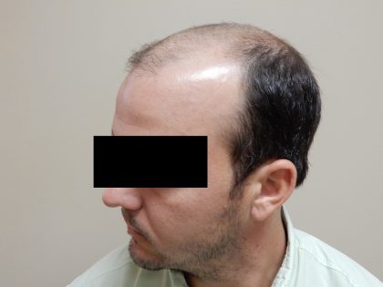Hair Restoration Before & After Patient #243