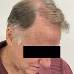 Hair Restoration Before & After Patient #242