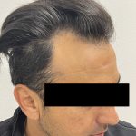 Hair Restoration Before & After Patient #245