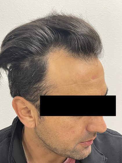 Hair Restoration Before & After Patient #245