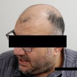 Hair Restoration Before & After Patient #244