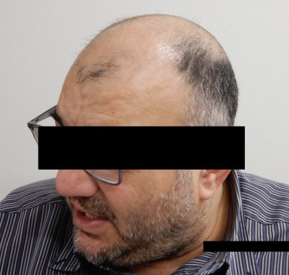 Hair Restoration Before & After Patient #244