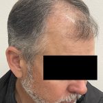 Hair Restoration Before & After Patient #247