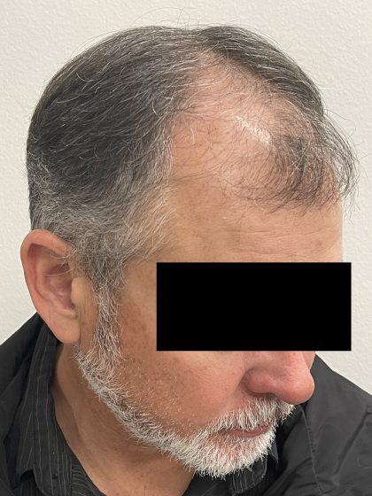 Hair Restoration Before & After Patient #247
