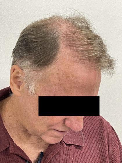 Hair Restoration Before & After Patient #242
