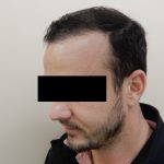 Hair Restoration Before & After Patient #243