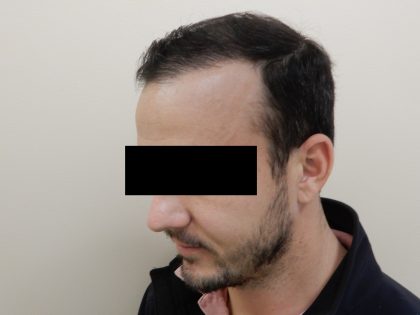 Hair Restoration Before & After Patient #243