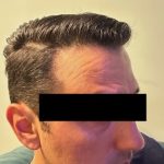 Hair Restoration Before & After Patient #245