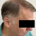 Hair Restoration Before & After Patient #242