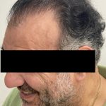 Hair Restoration Before & After Patient #244