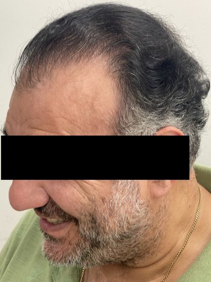 Hair Restoration Before & After Patient #244
