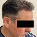 Hair Restoration Before & After Patient #247