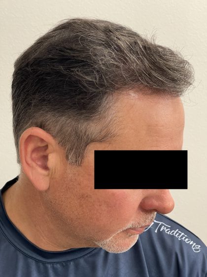 Hair Restoration Before & After Patient #247