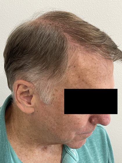 Hair Restoration Before & After Patient #242
