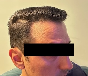 Hair Restoration Before & After Patient #245