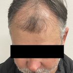 Hair Restoration Before & After Patient #247