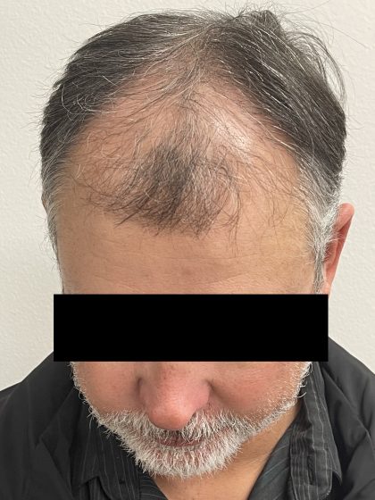 Hair Restoration Before & After Patient #247