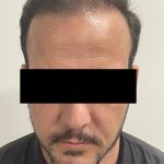 Hair Restoration Before & After Patient #243