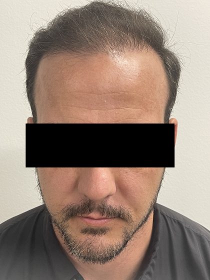 Hair Restoration Before & After Patient #243