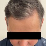 Hair Restoration Before & After Patient #247