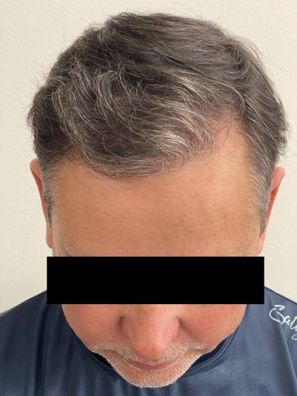 Hair Restoration Before & After Patient #247