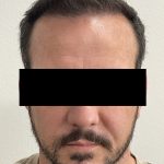 Hair Restoration Before & After Patient #243
