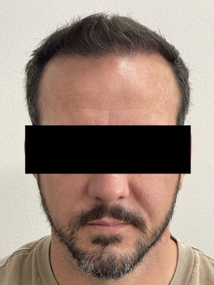 Hair Restoration Before & After Patient #243